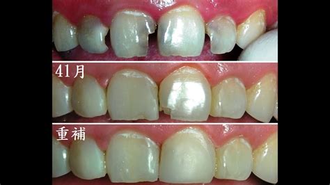 門牙一大一小|門牙缺角、牙齒破洞可以補嗎？6種補牙方式、價錢總。